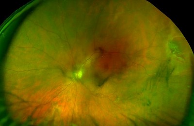 What Are Floaters? Massive Floaters and Retina Hole. Indication for Vitrectomy