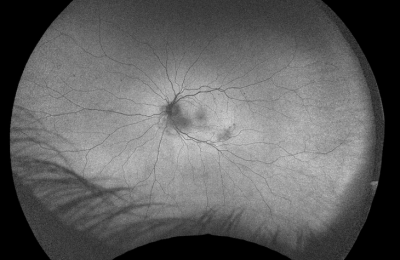 What Are Floaters? Massive and diffuse floaters color fundus and autofluorescence ( type 3) - better result with vitrectomy